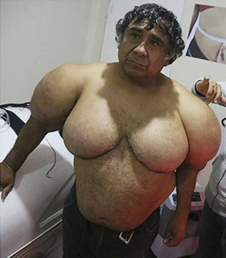 buzo-nitrogeno La triste historia de Alejandro Ramos que se le deformo el cuerpo por el nitrógeno