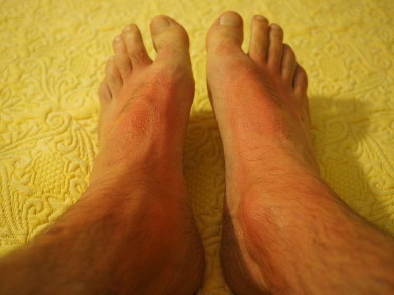 Cómo reducir los callos y asperezas de los pies