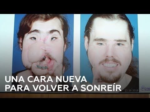 recibe-un-rostro-nuevo-tras-su-intento-de-suicidio Recibe un rostro nuevo tras su intento de suicidio